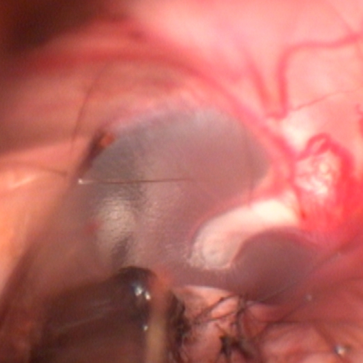 Video-otoscopy